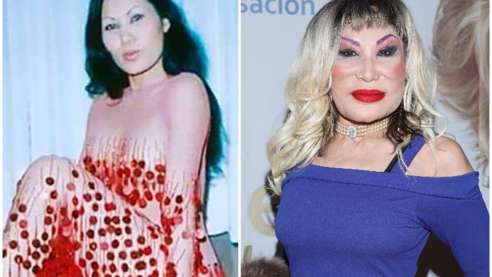 Cirugías plásticas fallidas: antes y después de estos famosos