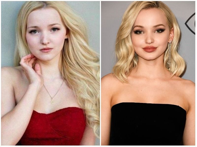 4 lần phẫu thuật thẩm mỹ của Dove Cameron