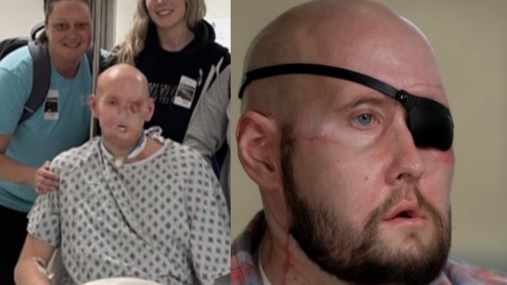 AARON JAMES Y SU TRASPLANTE DE ROSTRO1.jpg