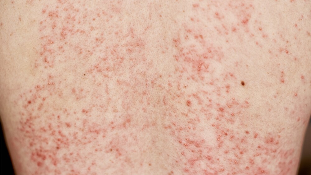 Tips para eliminar el acné en la espalda